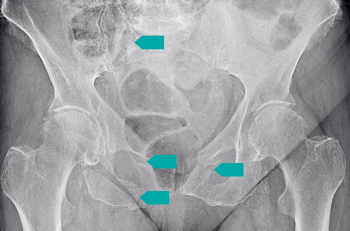kreuzbeinbruch geburt - Kann man am Kreuzbein operiert werden