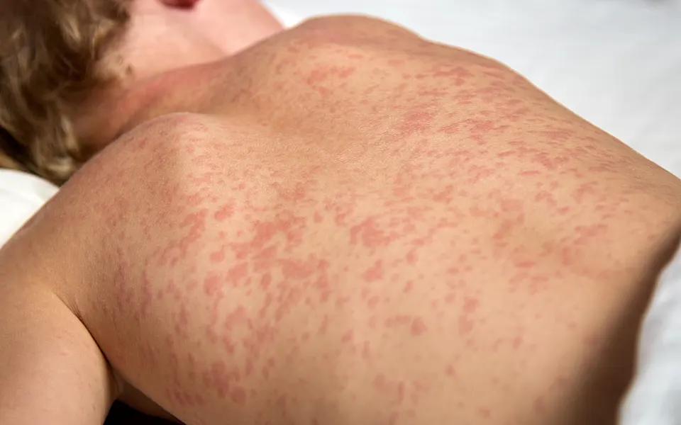 Husten und Ausschlag: Eine mögliche Verbindung? - Kann man bei Bronchitis Ausschlag bekommen husten und ausschlag - Kann man bei Bronchitis Ausschlag bekommen