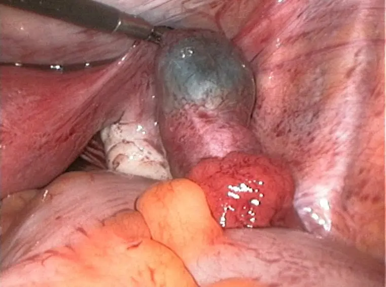 ektopisch schwangerschaft - Kann man bei einer Eileiterschwangerschaft das Kind austragen