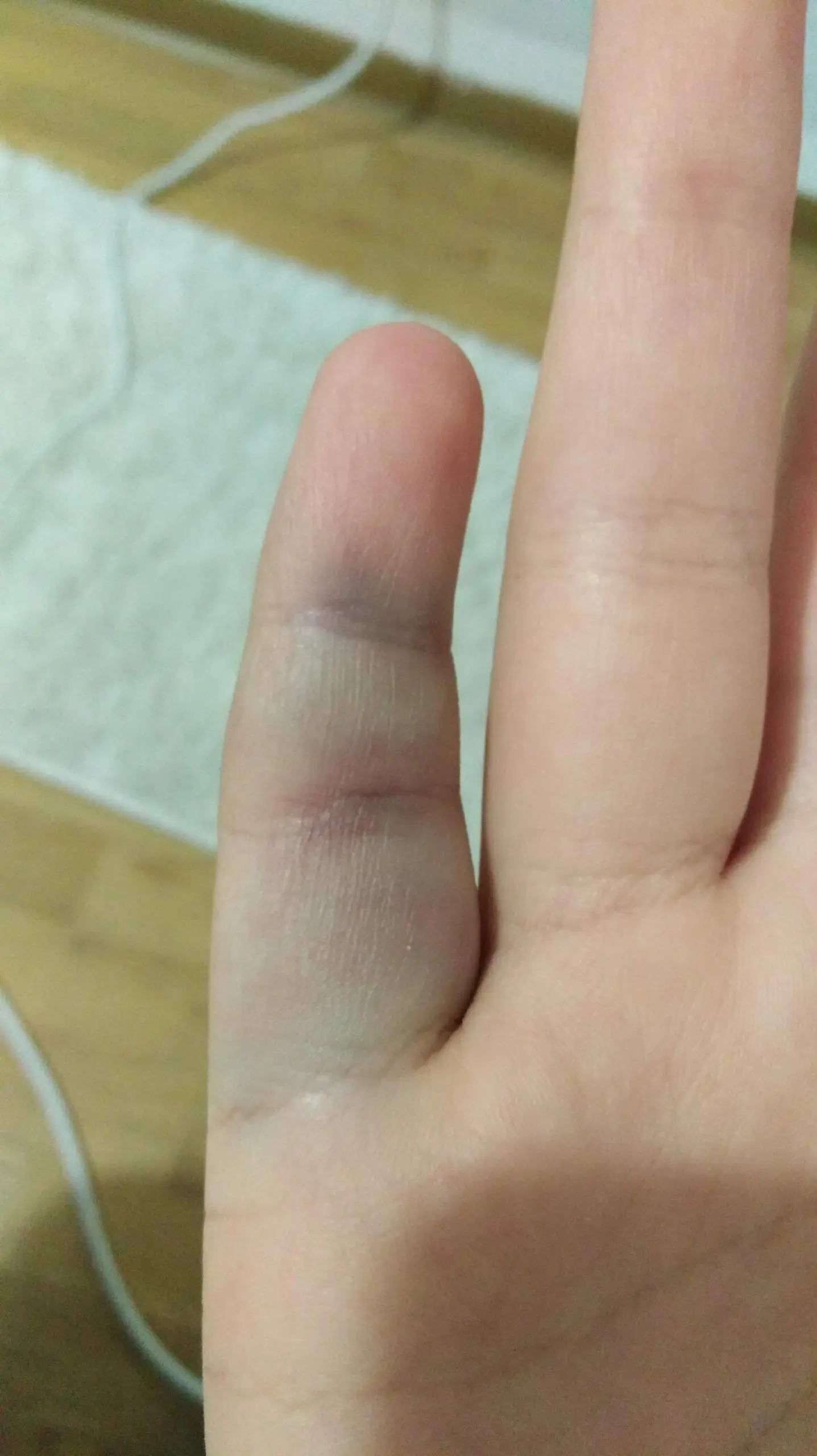 finger prellung - Kann man bei einer Prellung den Finger bewegen