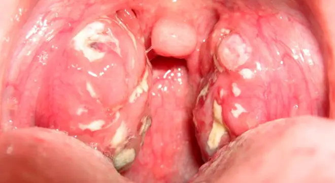 diphtherie-symptome - Kann man Diphtherie trotz Impfung bekommen