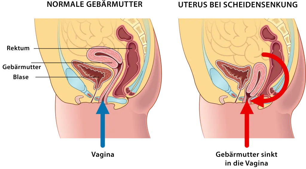 gebärmuttersenkung behandeln - Kann man eine Gebärmuttersenkung rückgängig machen