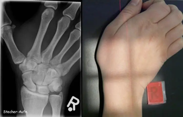 bruch erkennen - Kann man einen Bruch nicht bemerken