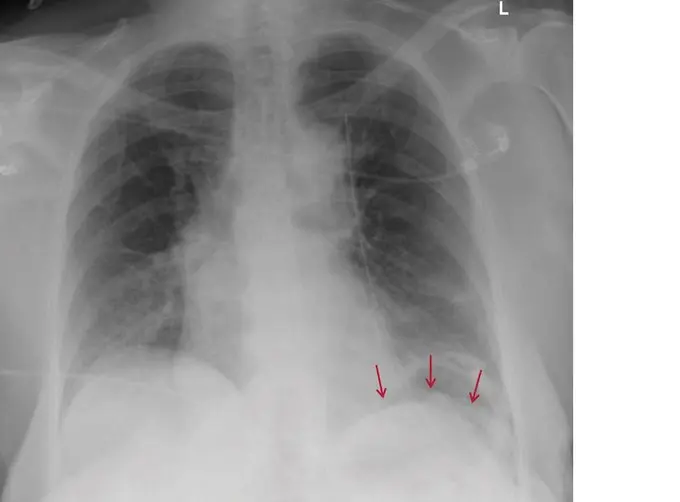 zwerchfellhochstand gefährlich - Kann man einen Zwerchfellhochstand operieren