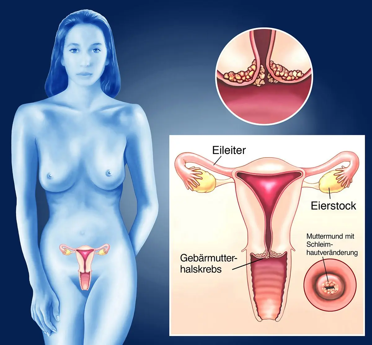 gebärmutterhalskrebs in der schwangerschaft festgestellt - Kann man Gebärmutterhalskrebs auf dem Ultraschall sehen