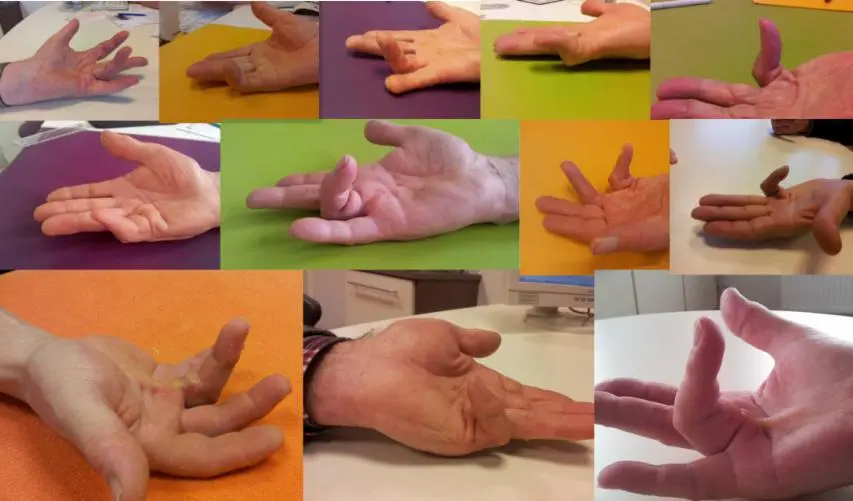 krumme finger seit geburt ursache - Kann man krumme Finger begradigen