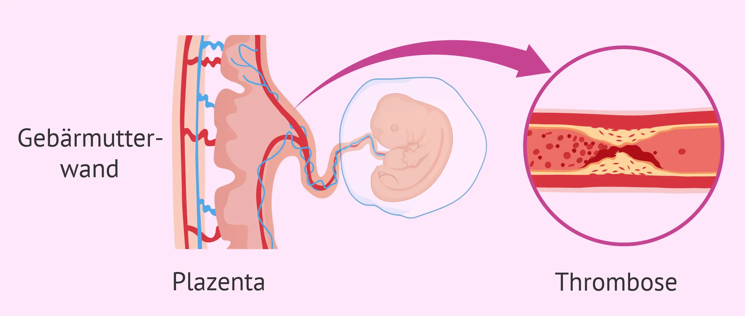 antiphospholipid antikörper schwangerschaft - Kann man mit APS schwanger werden