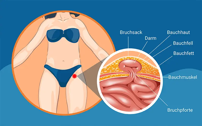 wie fühlt sich leistenbruch an - Kann man mit einem Leistenbruch noch laufen