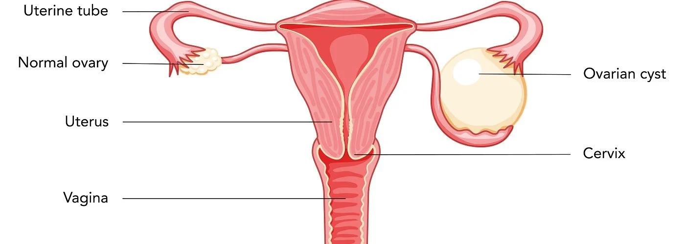 zyste eierstock schwangerschaft - Kann man mit einer Zyste im Eierstock schwanger werden