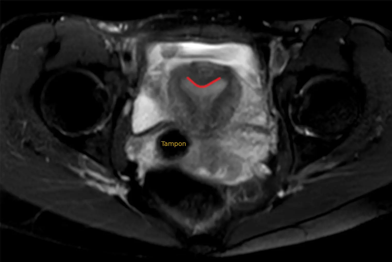 uterus arcuatus - Kann man mit Uterus bicornis schwanger werden