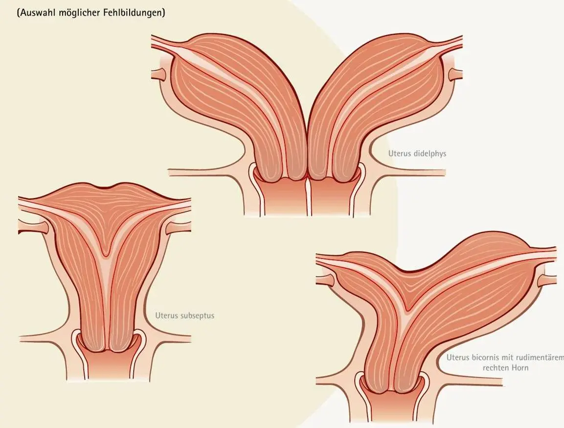 uterus subseptus schwangerschaft - Kann man mit Uterus Septus schwanger werden