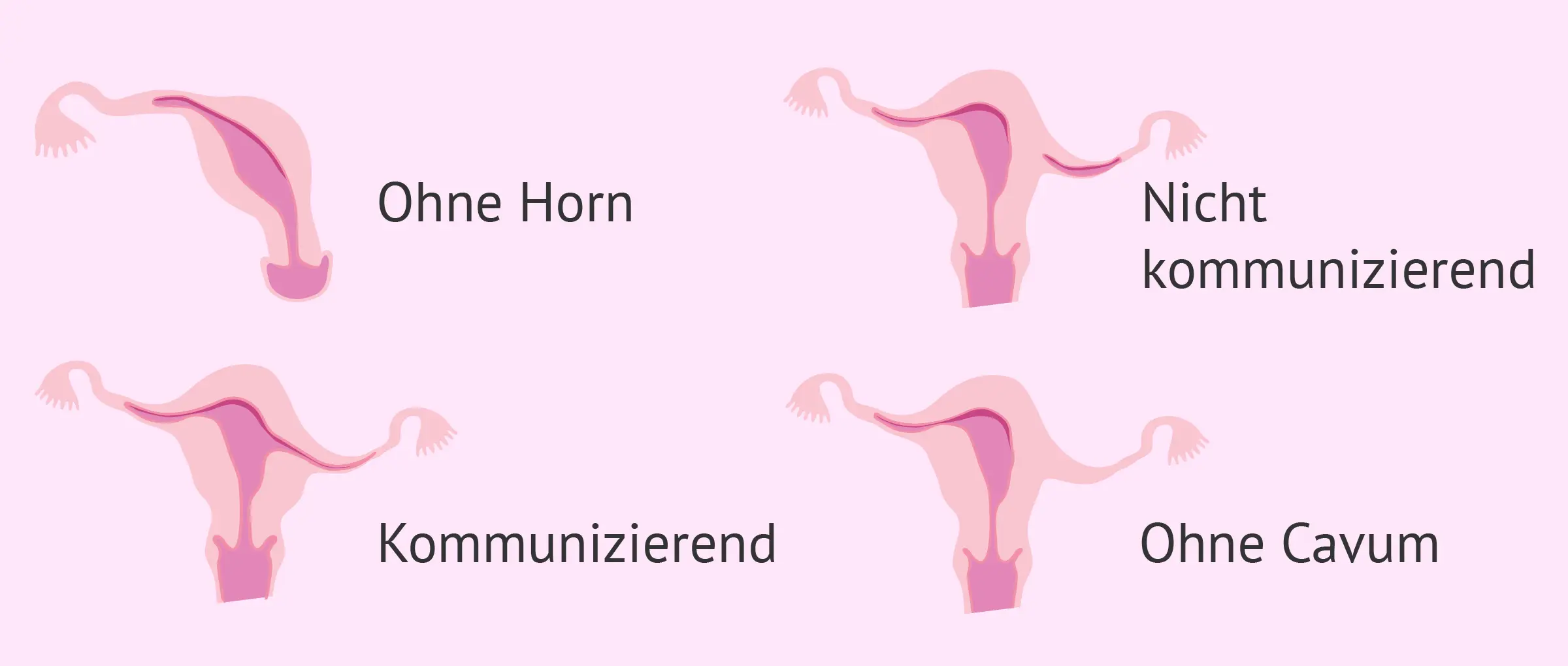 uterus unicornis schwangerschaft - Kann man mit Uterus Subseptus schwanger werden