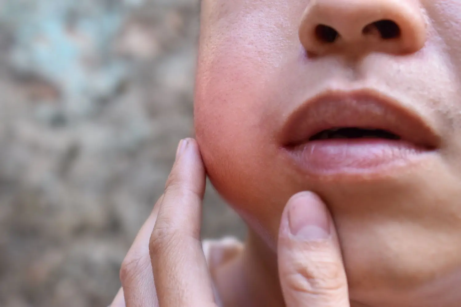 mumps ansteckend - Kann man Mumps bekommen obwohl man geimpft ist