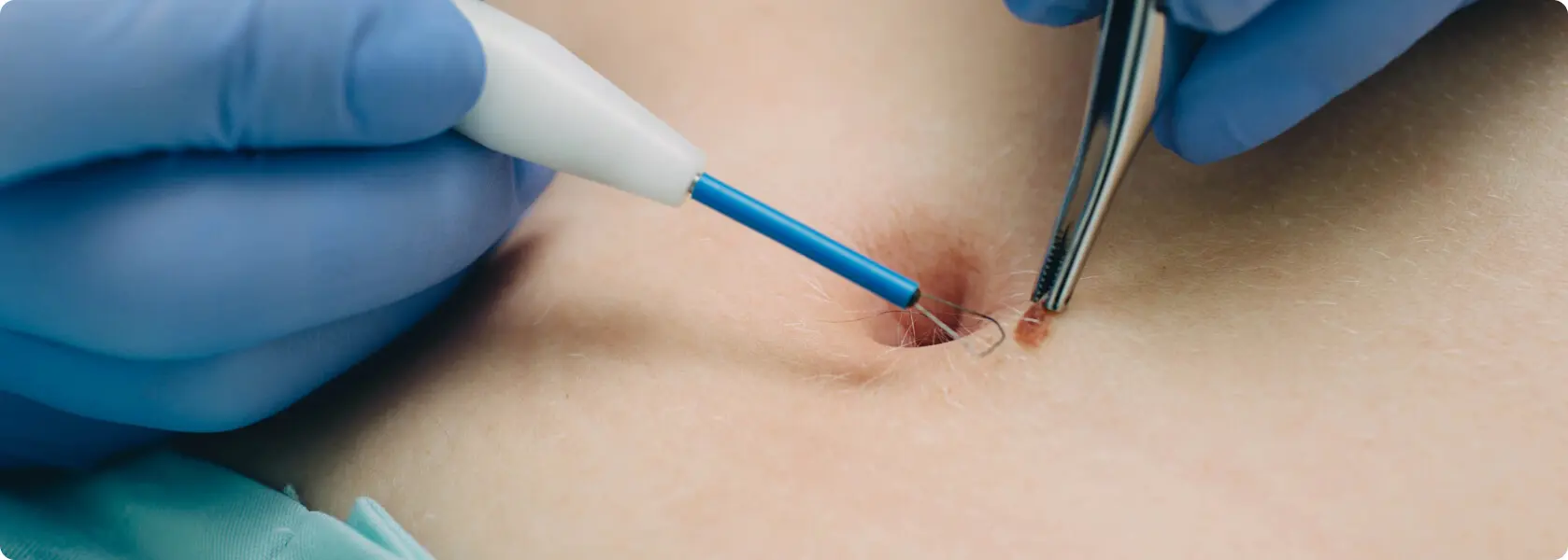 muttermal entfernen betäubung schwangerschaft - Kann man Muttermale in der Schwangerschaft entfernen lassen