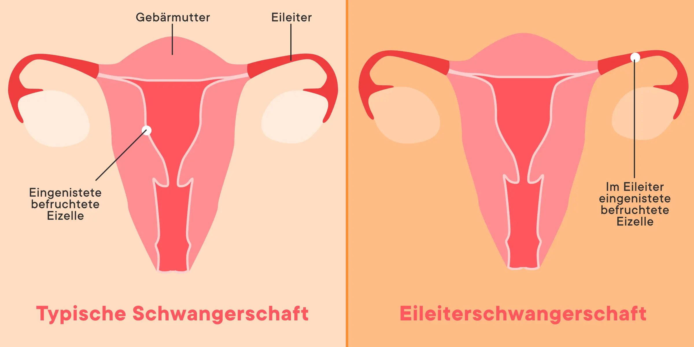 kann eine eileiterschwangerschaft noch zur normalen schwangerschaft werden - Kann man nach Eileiterschwangerschaft noch schwanger werden