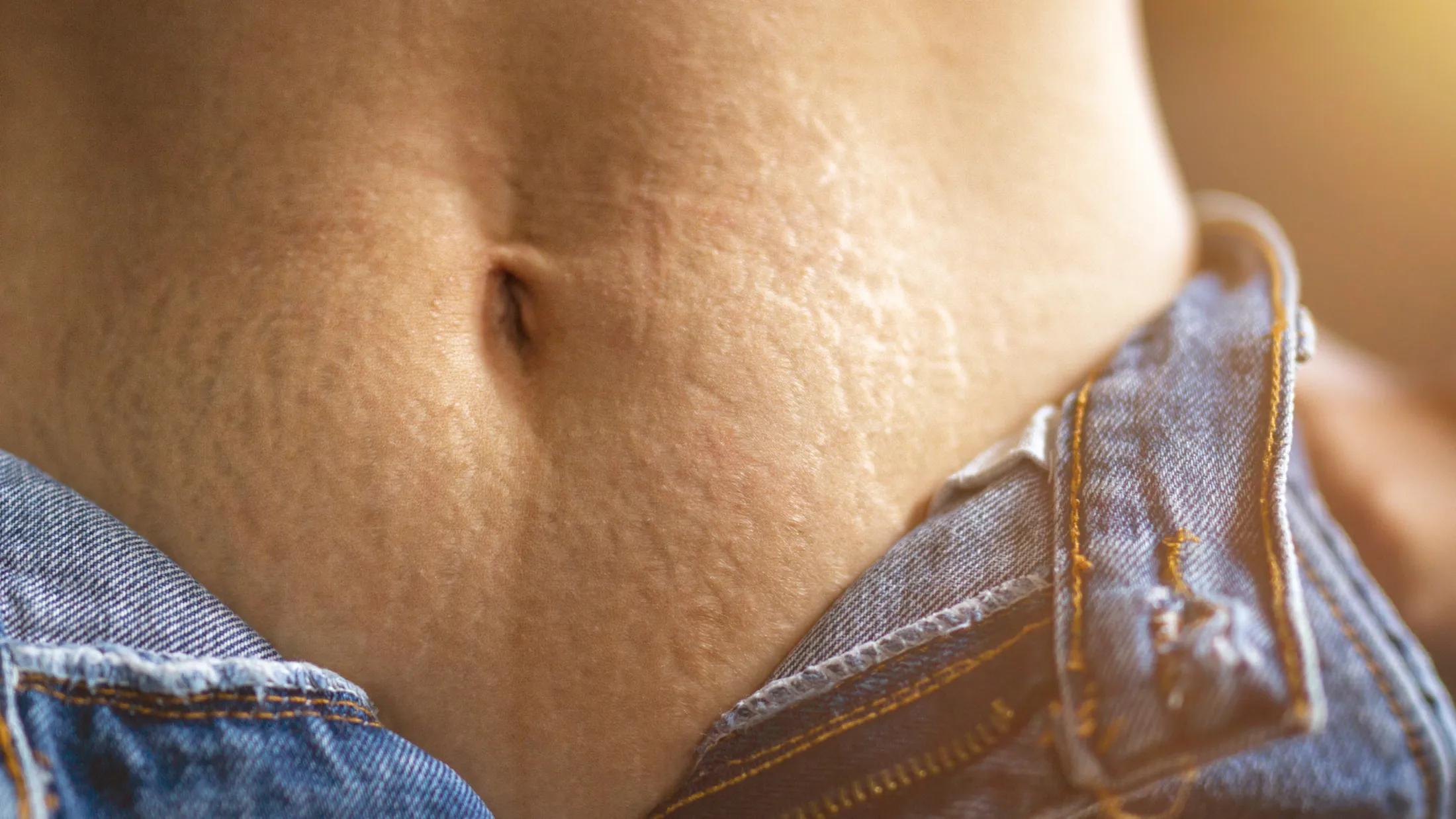 schwangerschaftsstreifen nach geburt behandeln - Kann man Schwangerschaftsstreifen Weg machen lassen