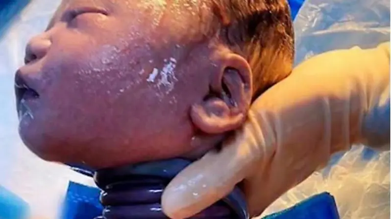 Nabelstrang um den Hals: Normale Geburt und Risiken - Kann man spüren wenn das Baby an der Nabelschnur zieht nabelschnur um hals normale geburt - Kann man spüren wenn das Baby an der Nabelschnur zieht