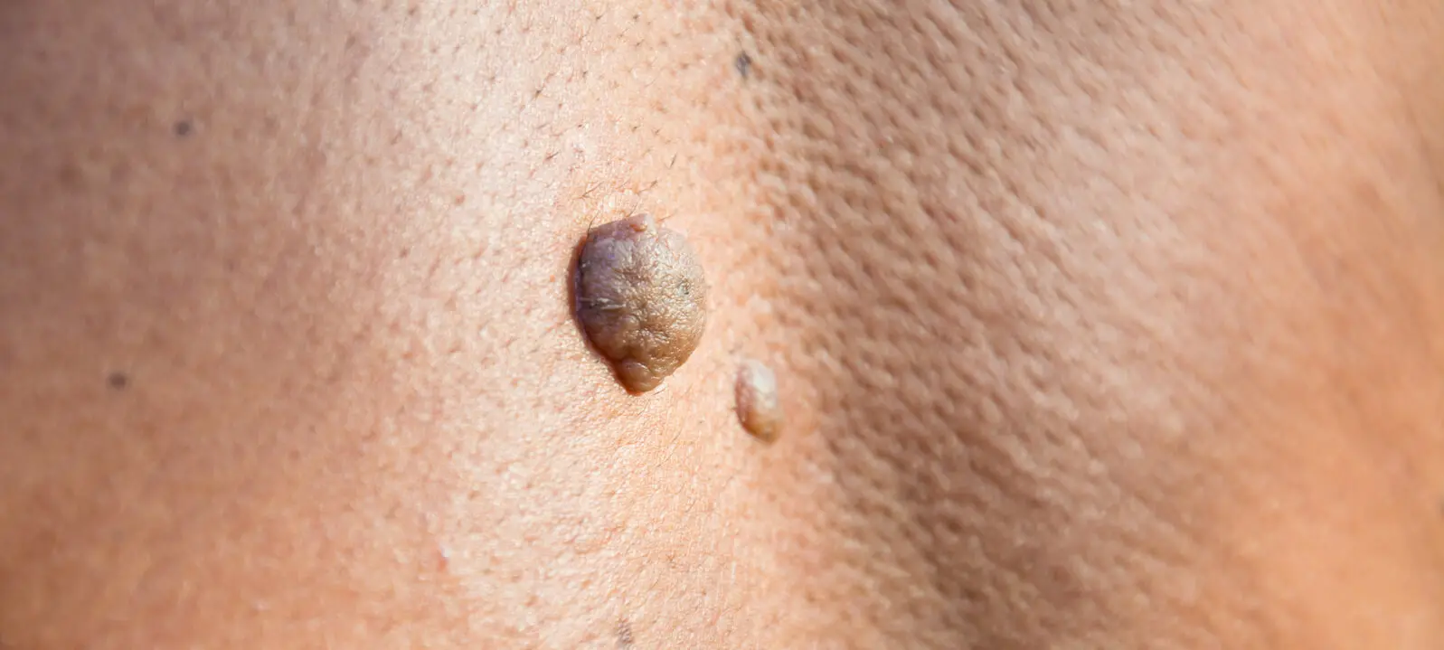 stielwarzen schwangerschaft - Kann man Stielwarzen in der Schwangerschaft entfernen