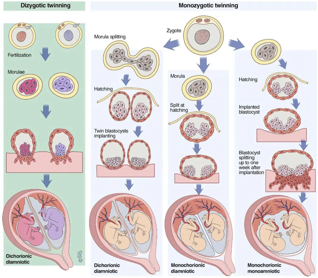 monochorial diamniot geburt - Kann man Vierlinge natürlich gebären