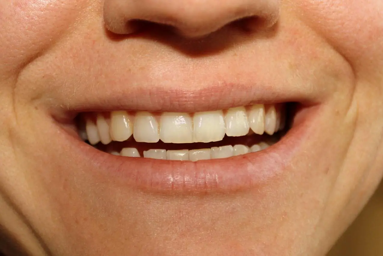 stillen zähne mutter - Kann man vom Stillen Karies bekommen