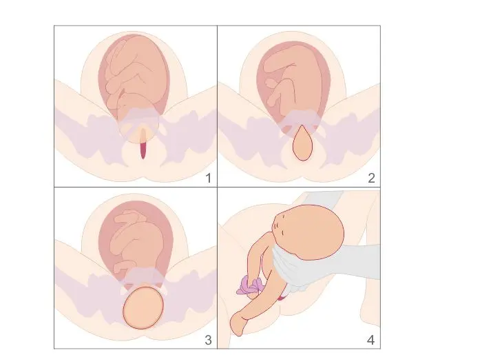 eröffnungsphase geburt dauer - Kann man während der Eröffnungsphase schlafen
