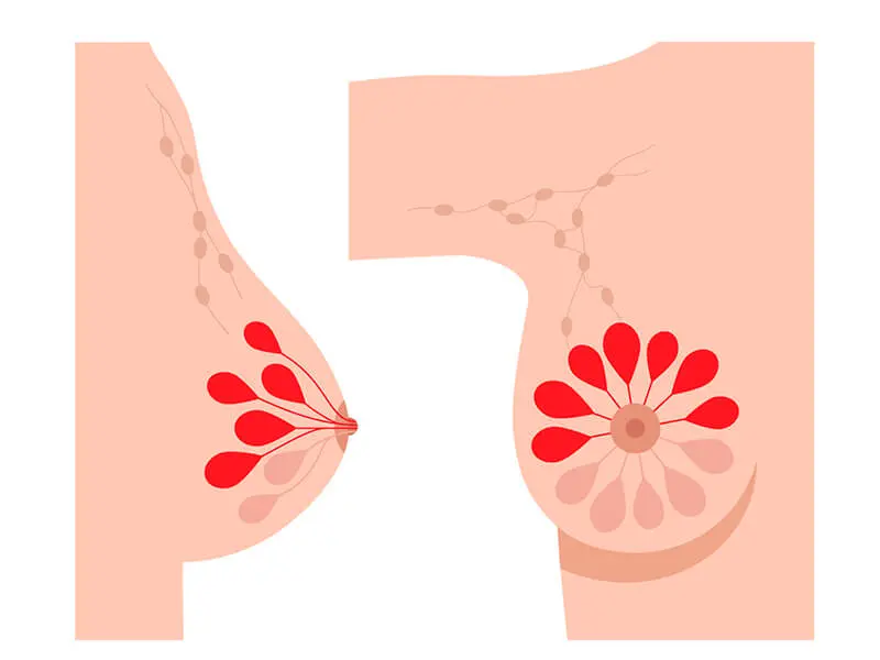 brustentzündung nach geburt - Kann Mastitis von alleine heilen
