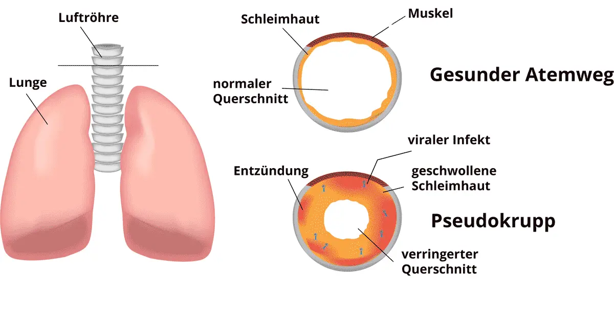 pseudokrupp erwachsener - Kann Pseudokrupp von alleine weg