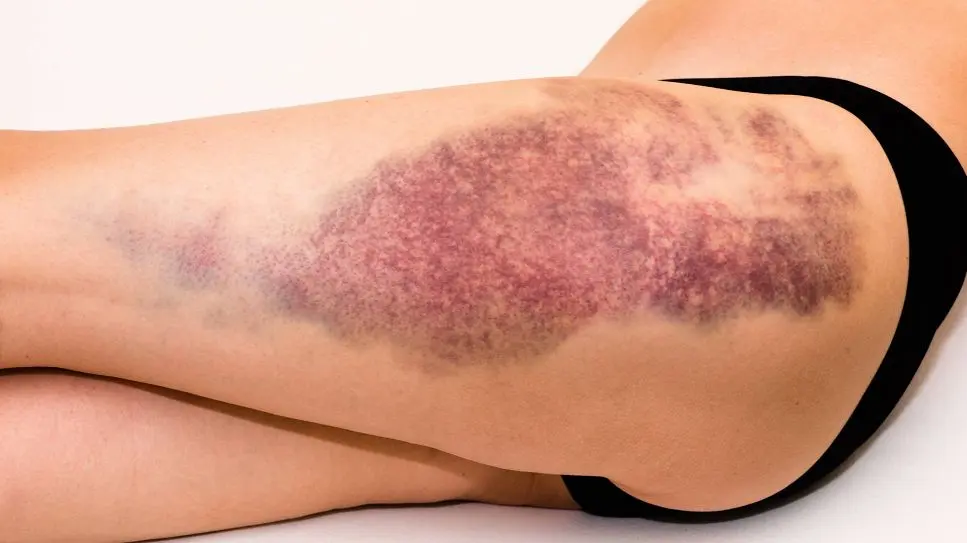 Blauer Fleck geschwollen: Alles Wissenswerte über Hämatome - Kann sich ein Bluterguss entzünden blauer fleck geschwollen - Kann sich ein Bluterguss entzünden