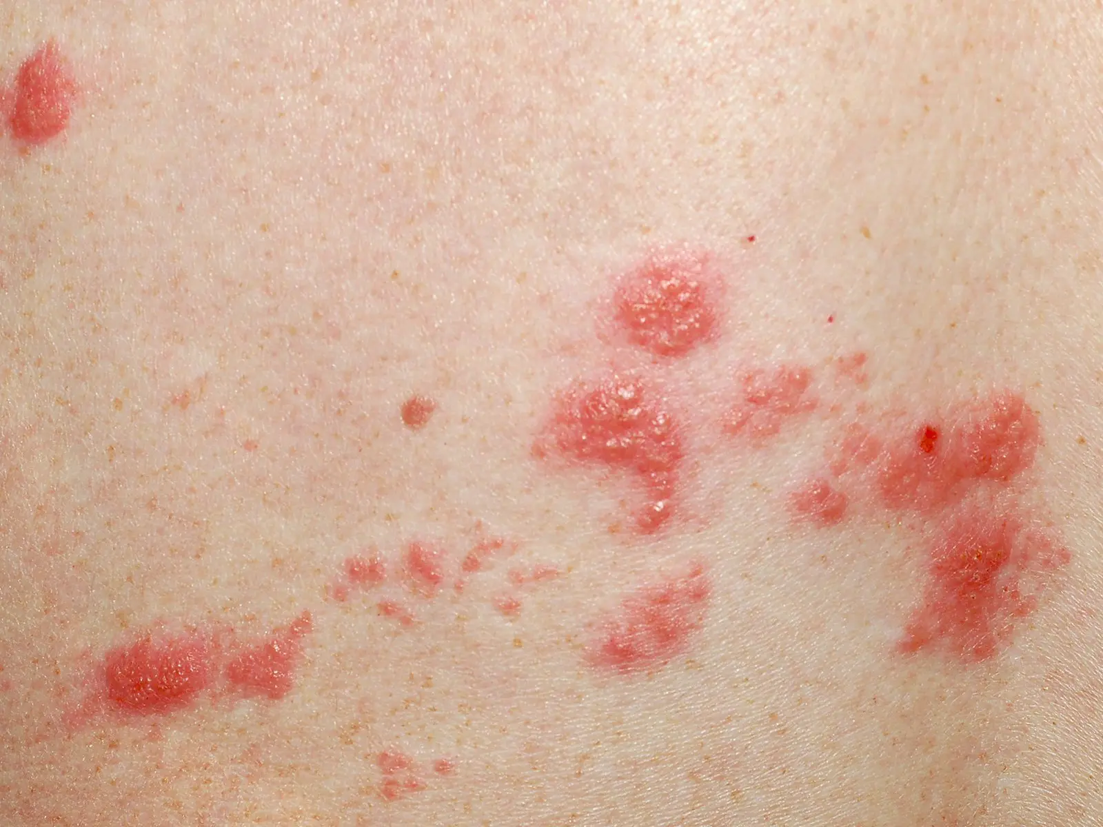 furunkel schwangerschaft - Kann sich ein Furunkel von alleine zurückbilden