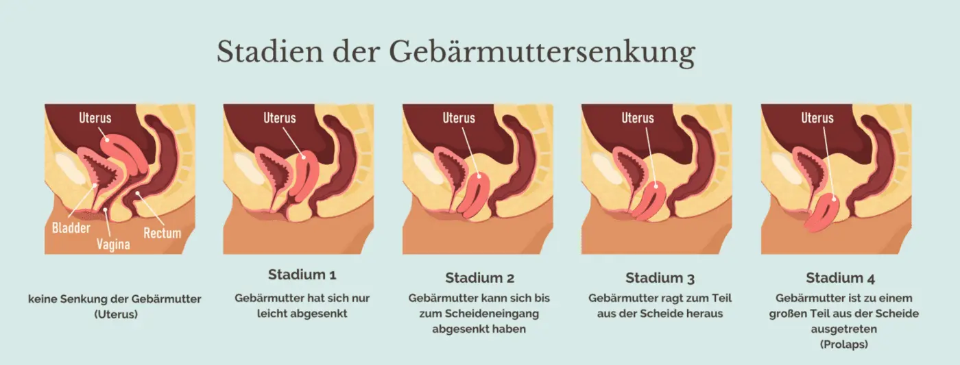 gebärmuttersenkung nach geburt - Kann sich eine Gebärmuttersenkung zurückbilden