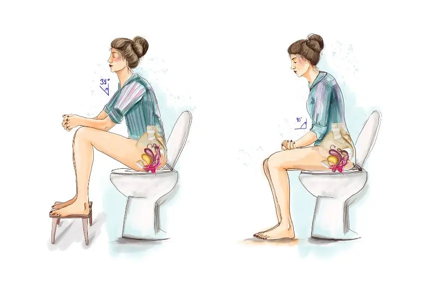 organsenkung nach geburt - Kann sich eine Senkung zurückbilden