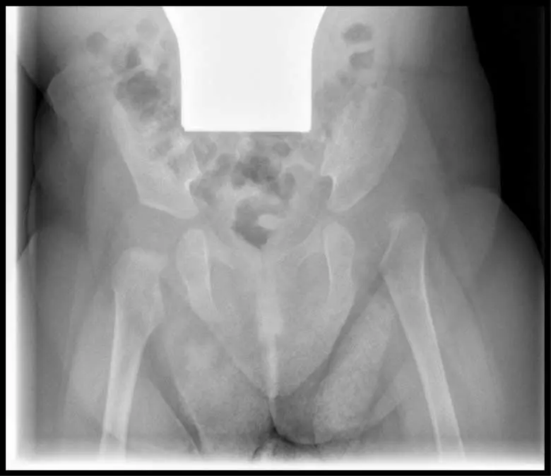 hüftdysplasie natürliche geburt - Kann sich Hüftdysplasie verwachsen