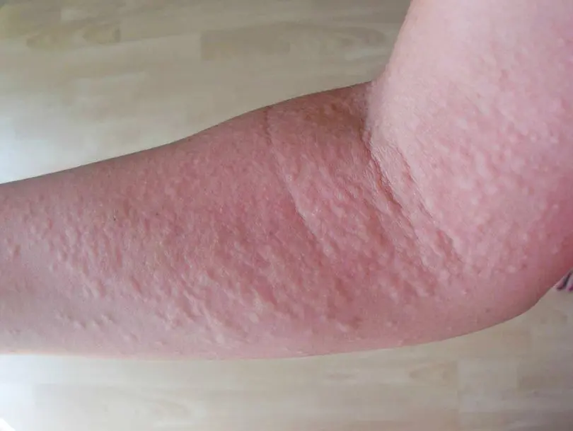 nesselsucht nach sport gefährlich - Kann Sport Nesselsucht auslösen