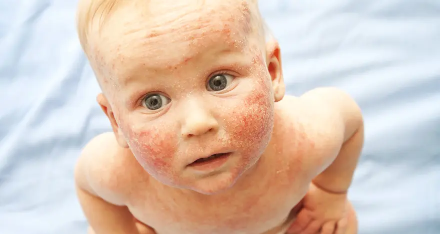 allergische reaktion kleinkind - Können 2 jährige Allergien haben