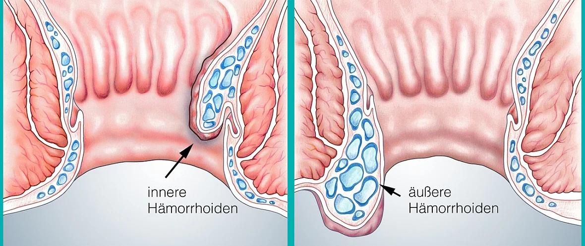 hämorrhoiden halbes jahr nach geburt - Können Hämorrhoiden dauerhaft bleiben