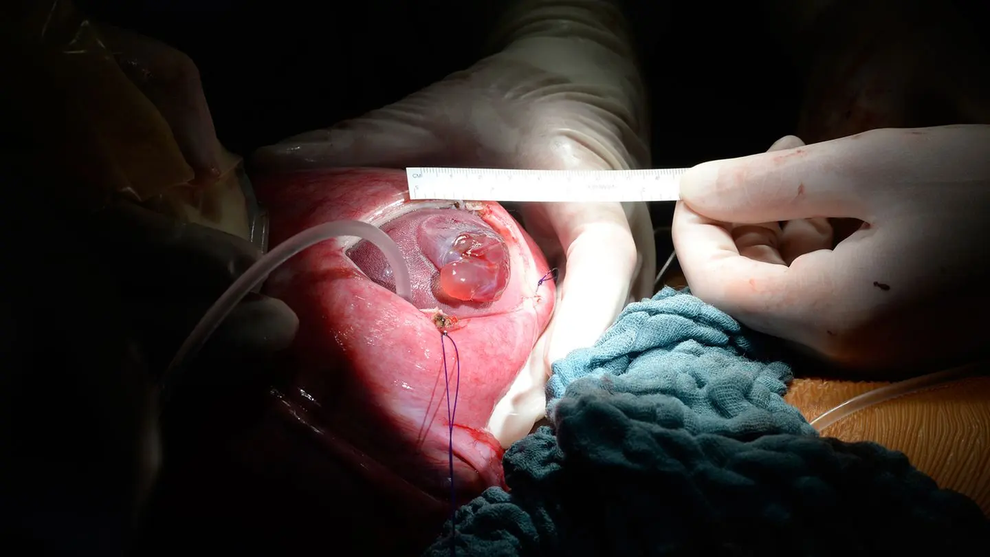 Spina Bifida Operation nach der Geburt: Was Sie wissen müssen - Können Kinder mit Spina bifida laufen spina bifida operation nach der geburt - Können Kinder mit Spina bifida laufen