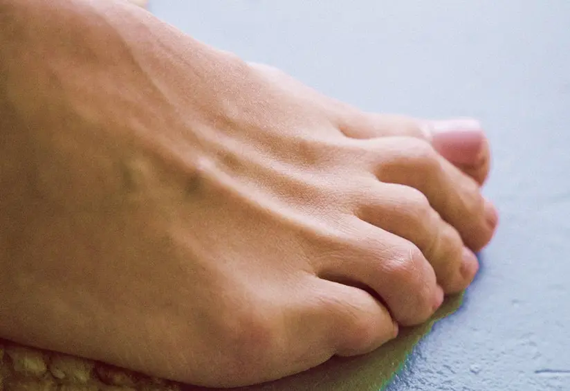 gekrümmte zehen - Können krumme Zehen wieder gerade werden