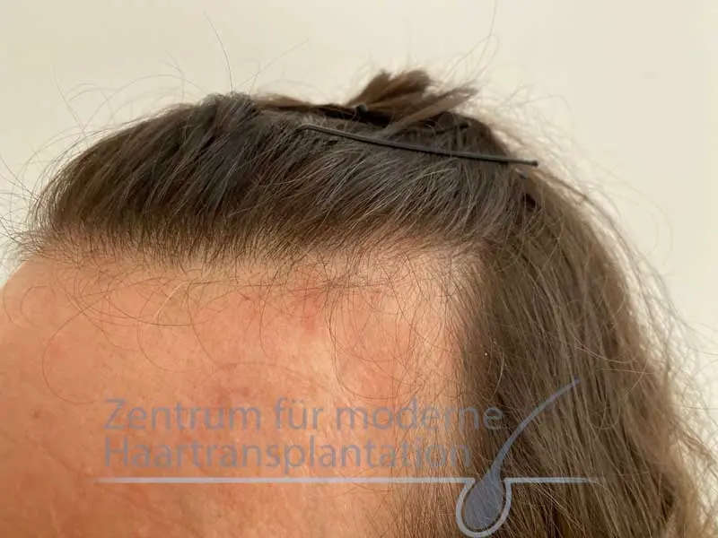 geheimratsecken frau von geburt an - Können Mädchen Geheimratsecken haben