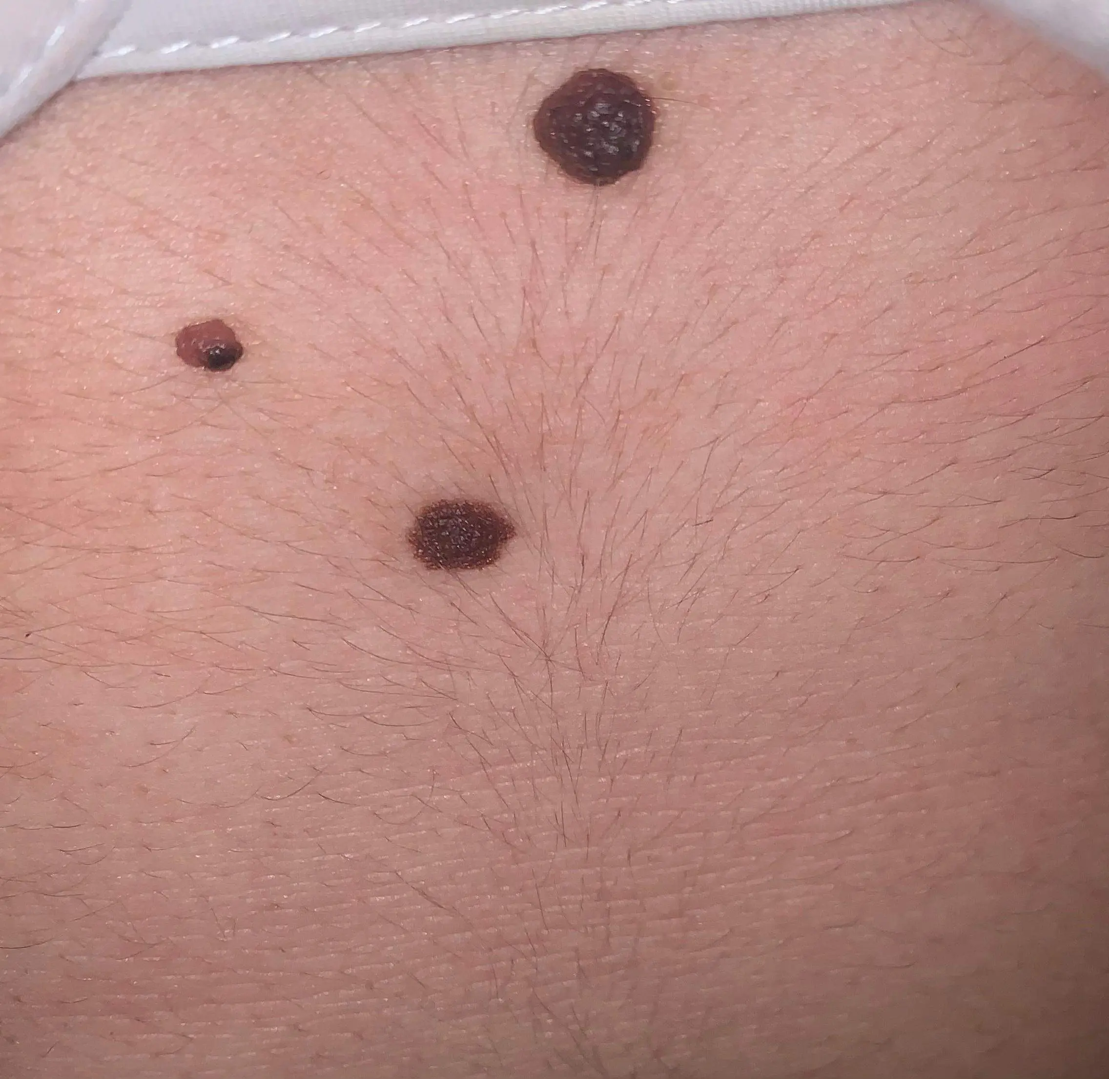 muttermal von geburt an - Können Muttermale im Laufe des Lebens kommen