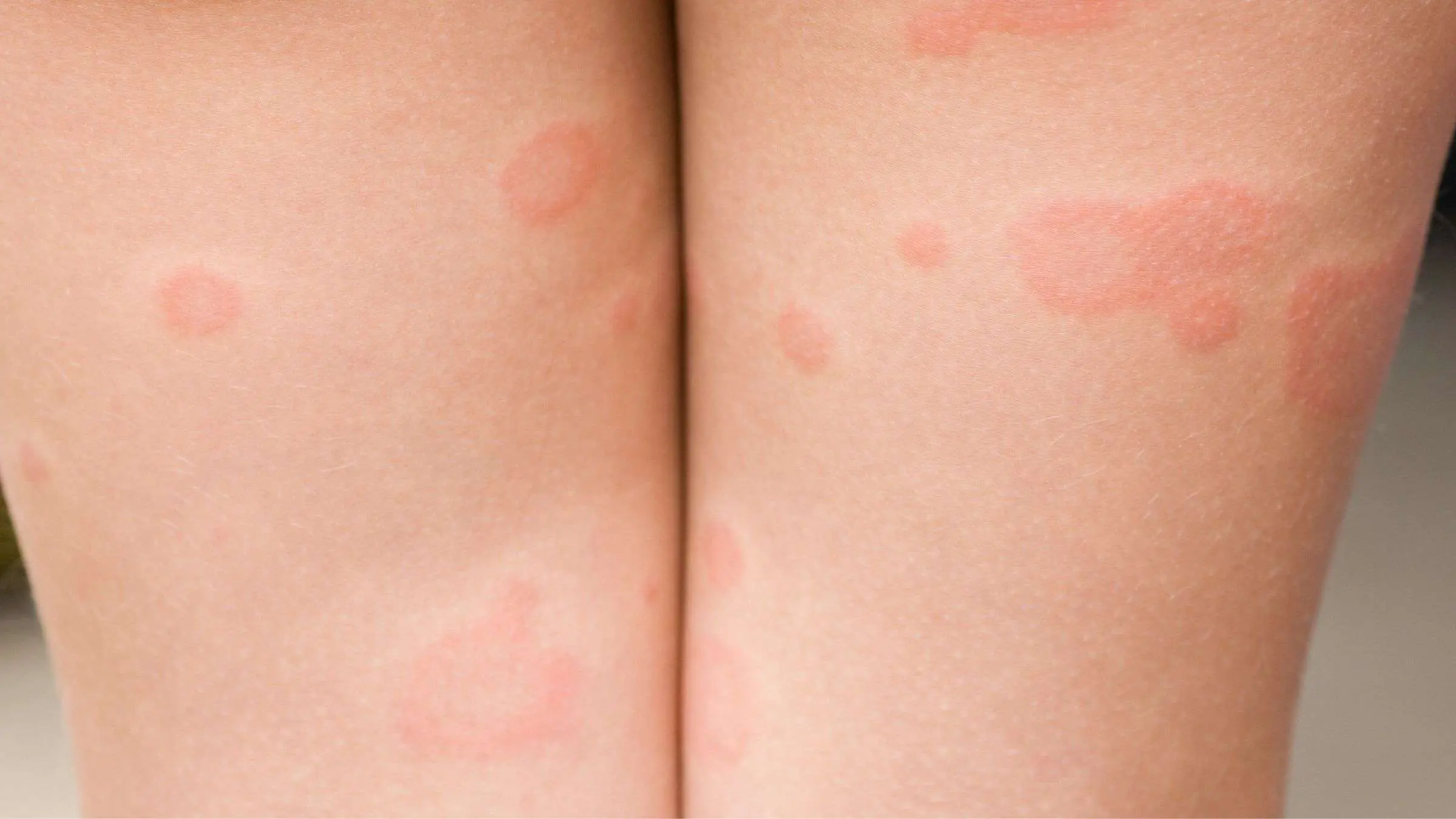 ringelröteln gelenkschmerzen - Können Ringelröteln Rheuma auslösen