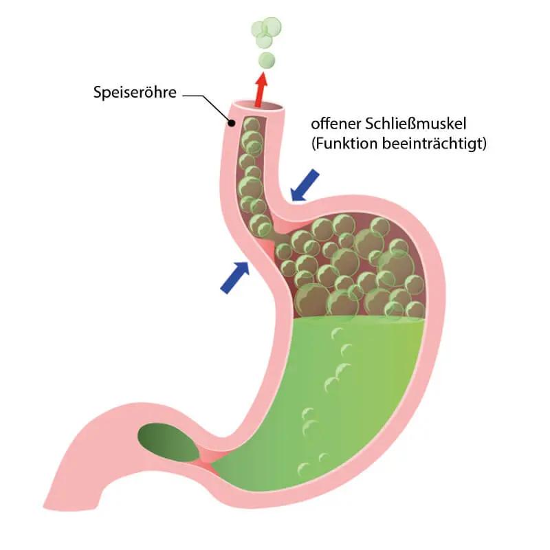 Abends Schluckbeschwerden: Ursachen, Symptome und Behandlung - Können Schluckbeschwerden harmlos sein abends schluckbeschwerden - Können Schluckbeschwerden harmlos sein