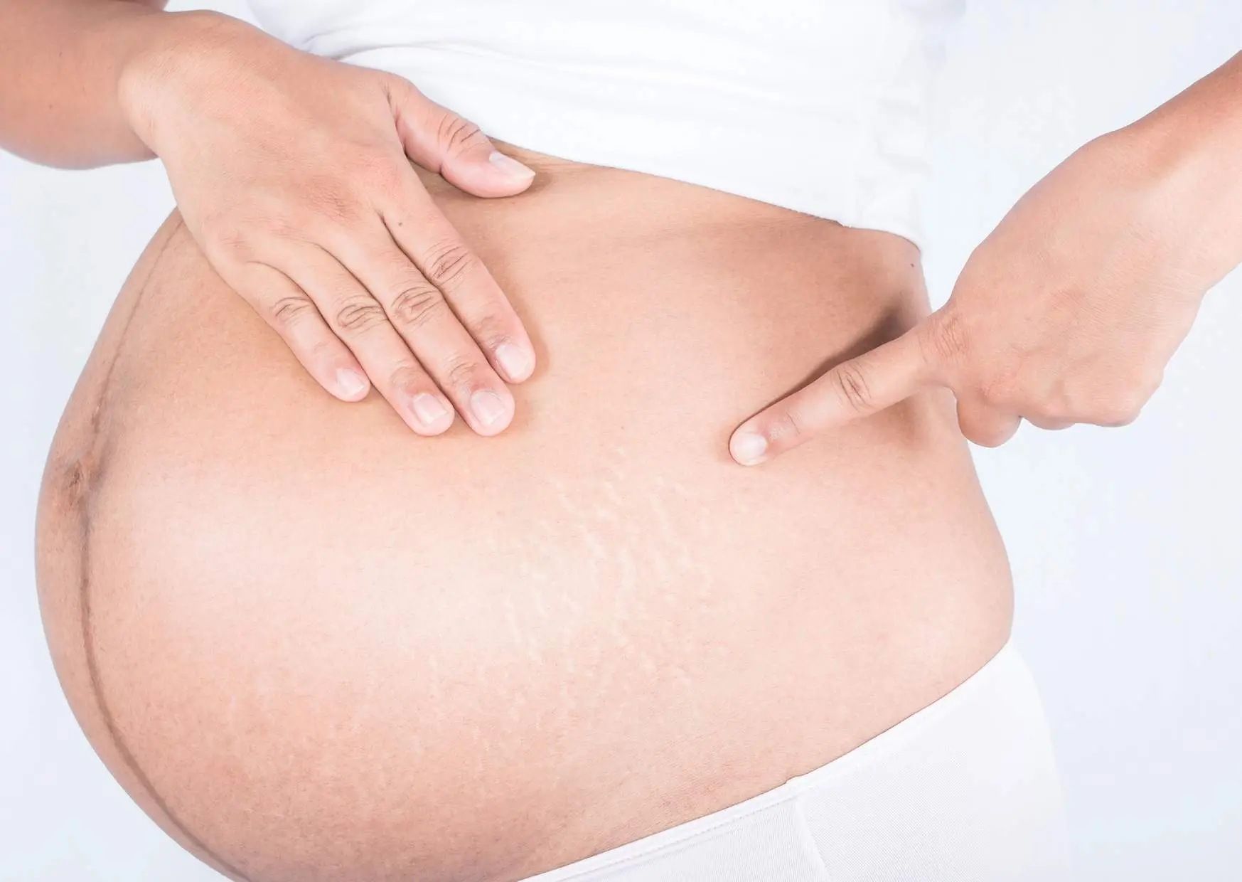 schwangerschaftsstreifen nach geburt - Können Schwangerschaftsstreifen wieder verschwinden