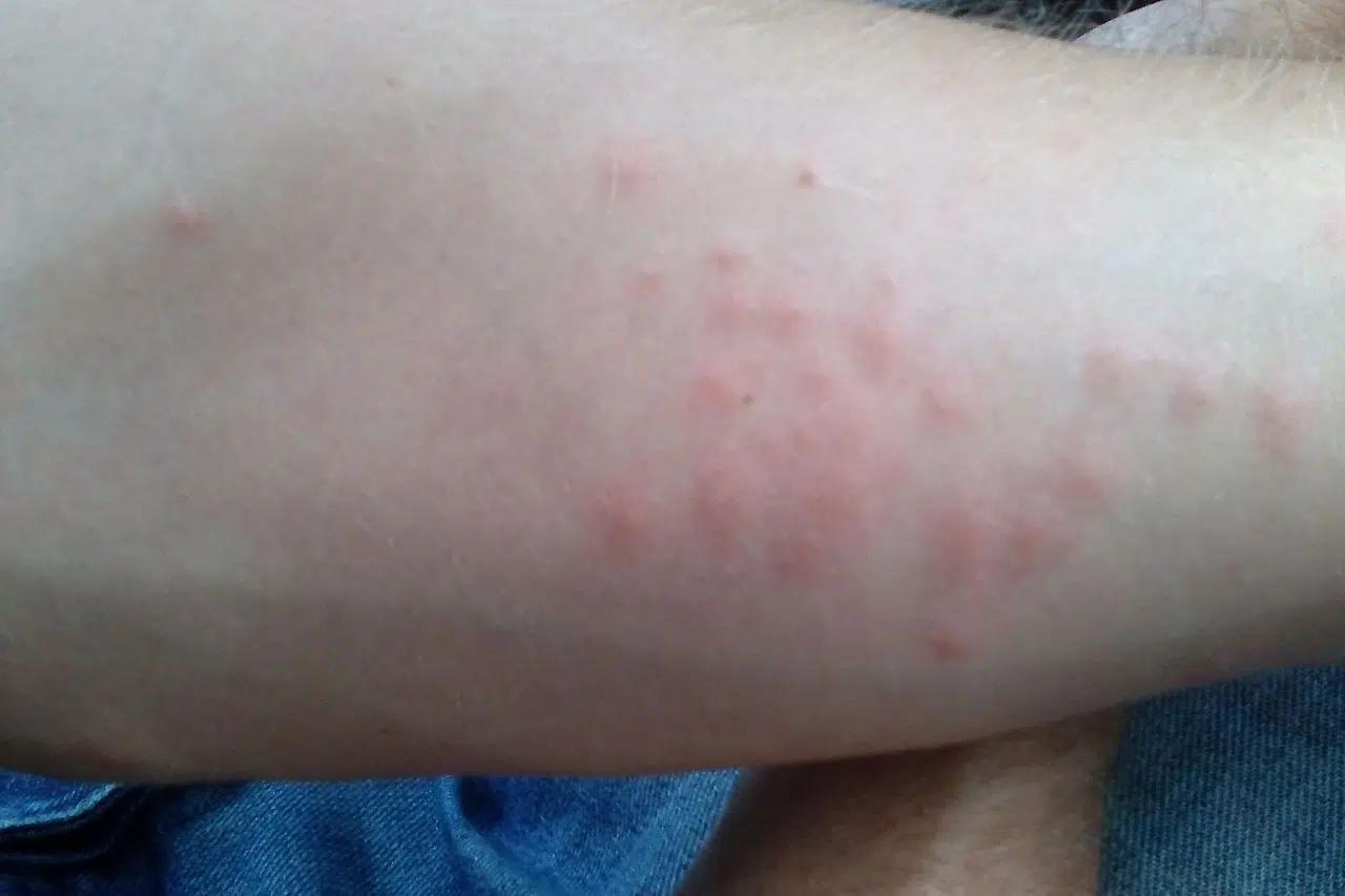 ameisenbisse behandeln - Sind Ameisenbisse schlimm