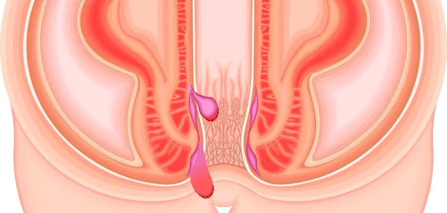 äußere hämorrhoiden - Sind äußere Hämorrhoiden schlimm