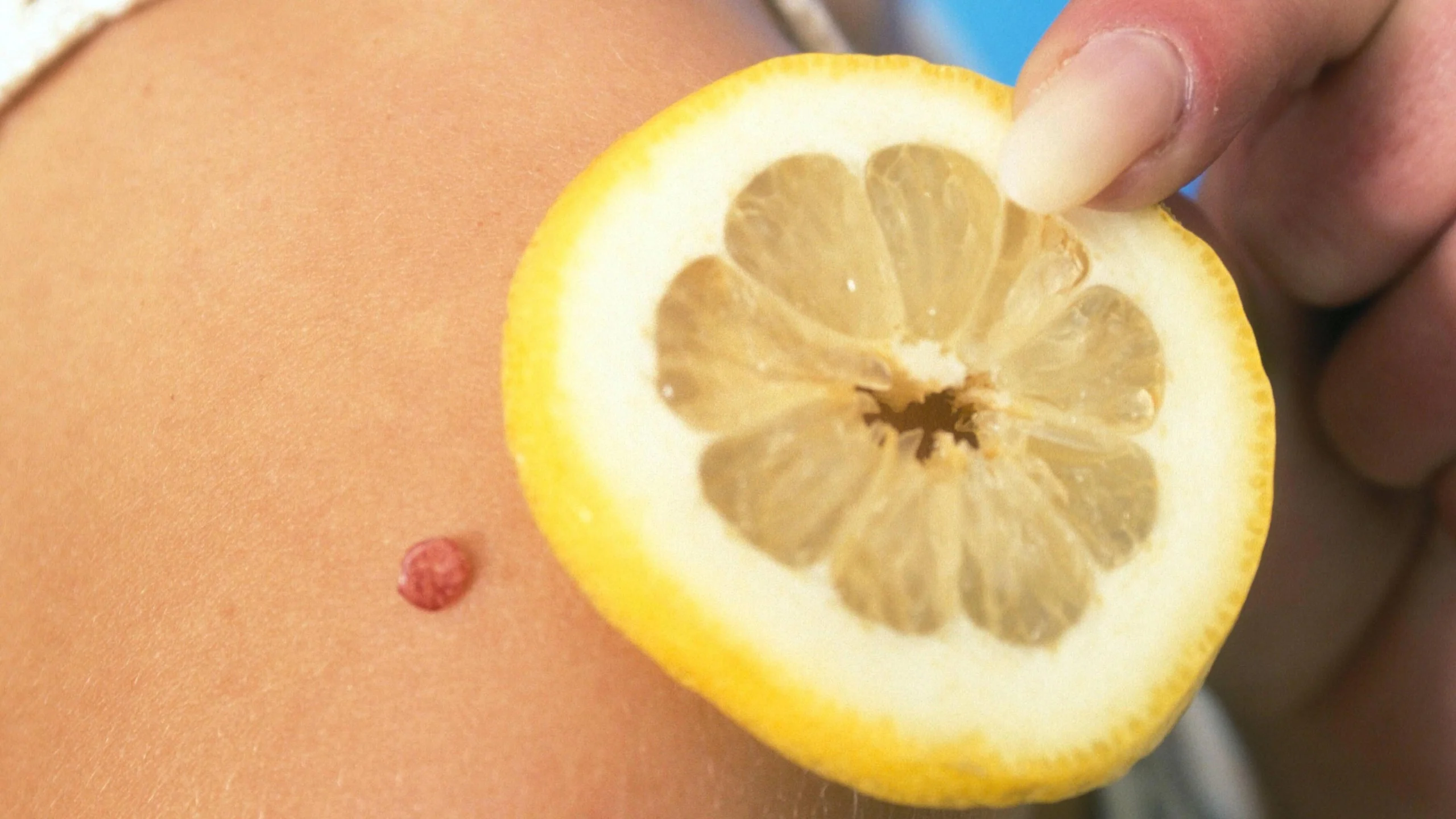 mückenstich schwangerschaft - Sind Insektenstiche in der Schwangerschaft gefährlich