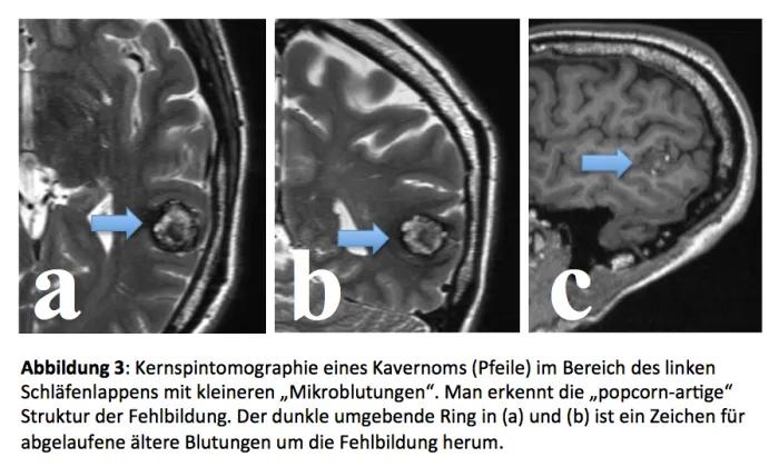 Kavernome: Was Sie über diese Gefäßmissbildungen wissen sollten - Sind Kavernome angeboren kavernom geburt - Sind Kavernome angeboren