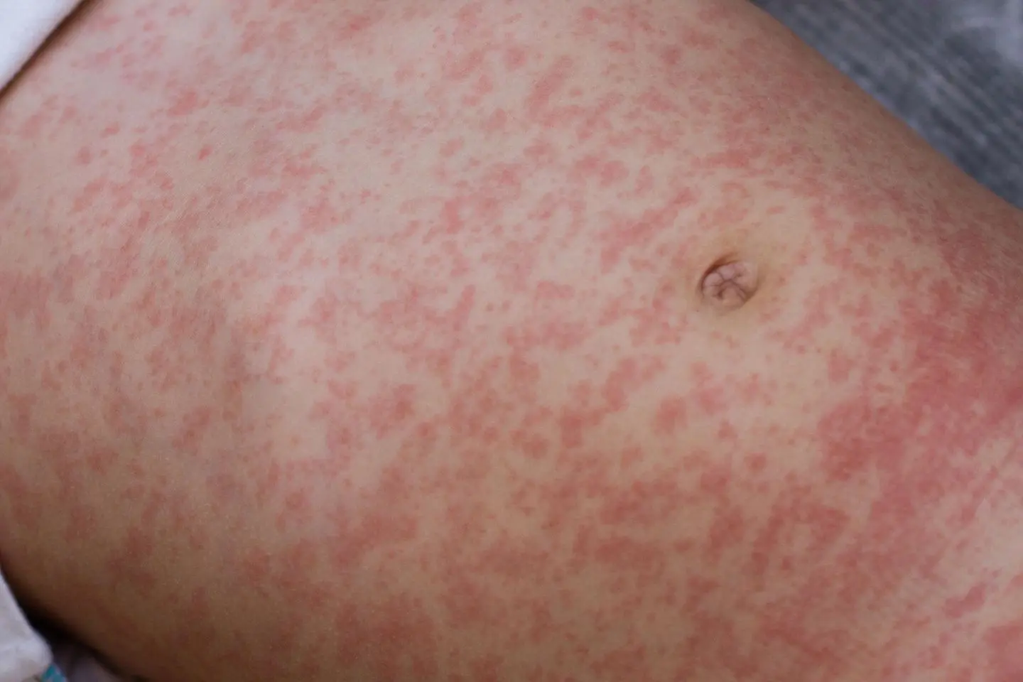 masern schwangerschaft - Sind Masern gefährlich für Baby