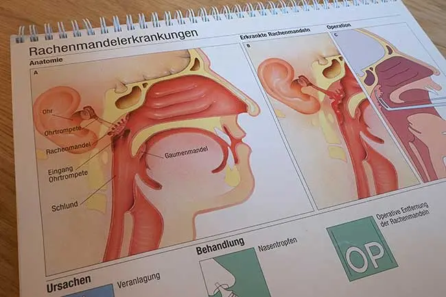 polypen bei kindern - Sind Polypen bei Kindern gefährlich
