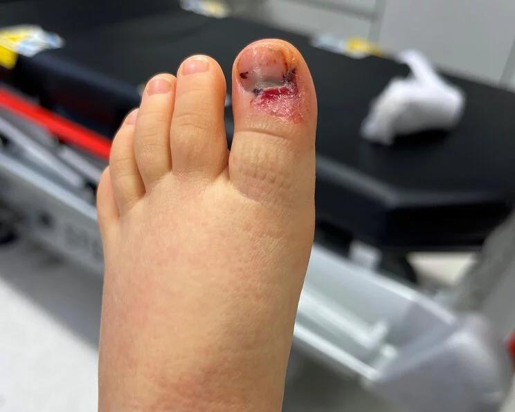 quetschung unter der haut - Sind Quetschungen gefährlich