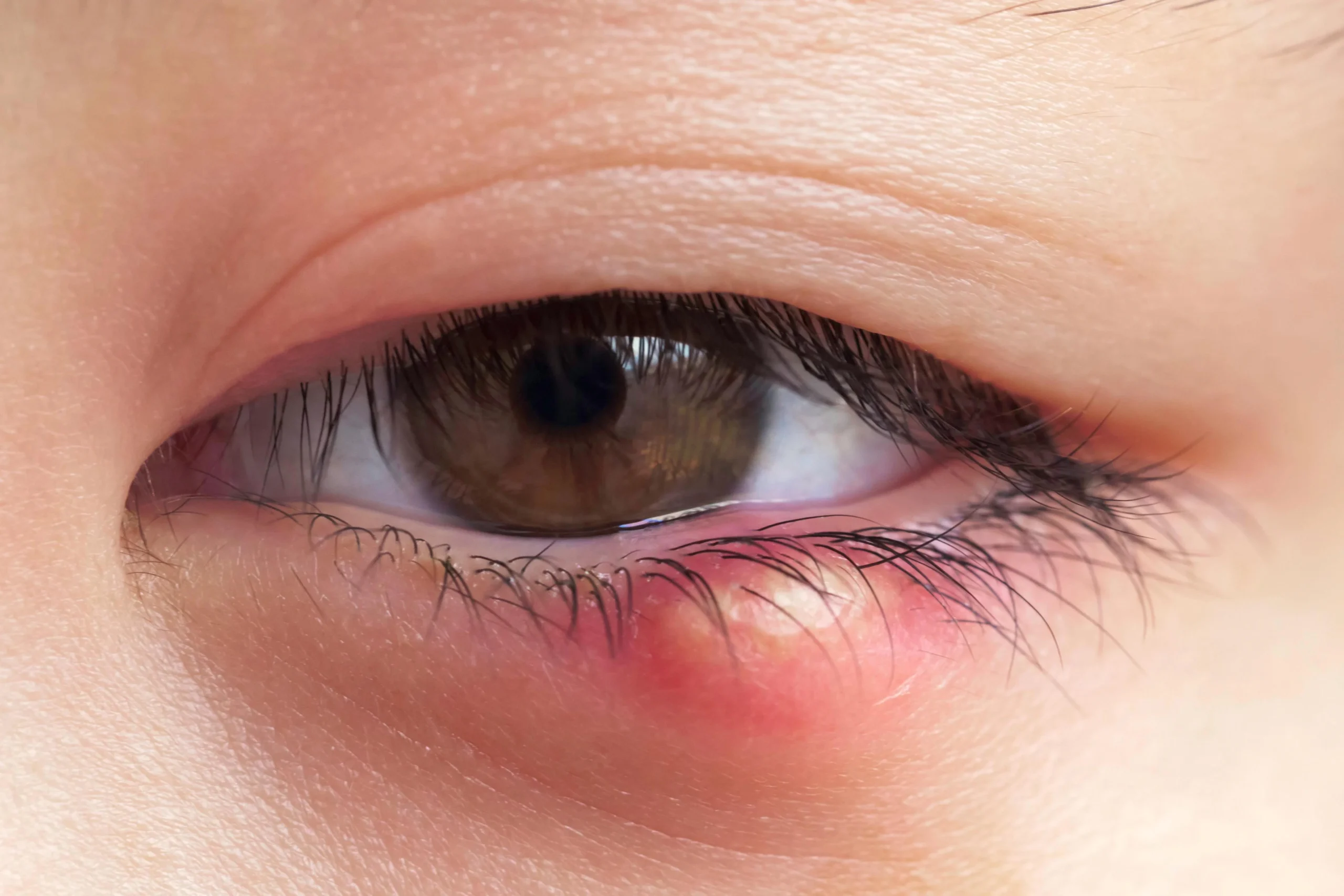 gerstenkorn kita - Sollte man bei Gerstenkorn zuhause bleiben